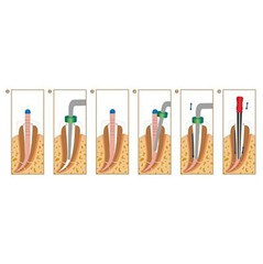 ORIGINAL Sybron Endo Buchanan System B Heat Plugger Elements Obturation Tip