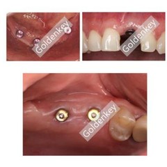 Healing Abutment Cap RC NC Titanium Fit Straumann ITI BLT Regular Narrow Cross
