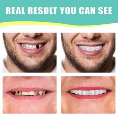 1Set Dentures Veneers Tooth,Dental Care Kits for 1 Count (Pack of 1), white
