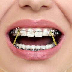 JMU Dental Orthodontic Elastics Intraoral Elastic Bands Latex Braces 100pcs/pk